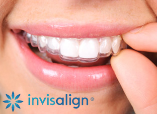 invisalign